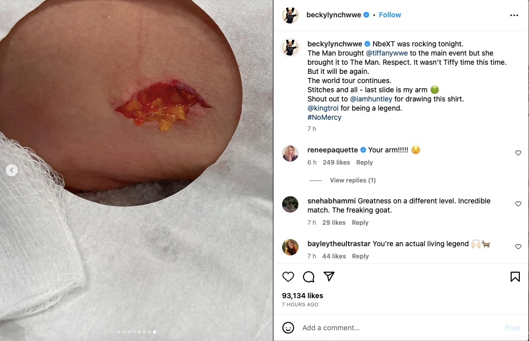Becky Lynch Elbow: Is She Really Hurt? Get the Latest Details Here
